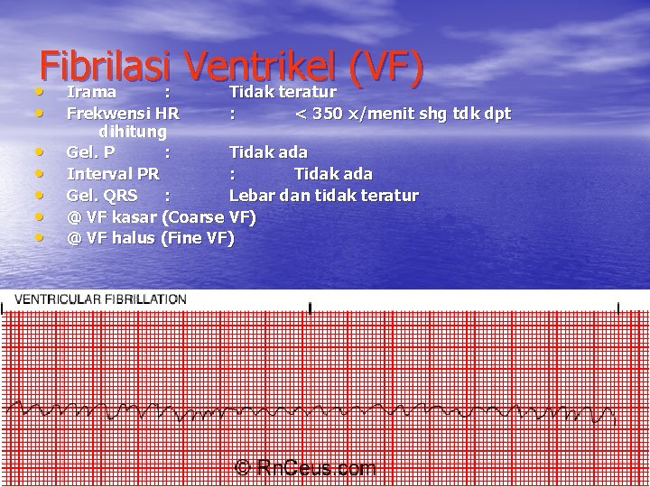 Fibrilasi Ventrikel (VF) • Irama : Tidak teratur • • • Frekwensi HR :
