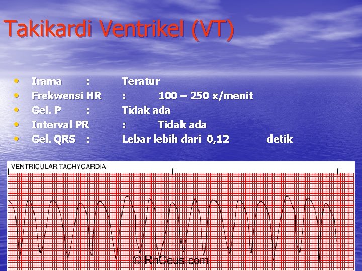 Takikardi Ventrikel (VT) • • • Irama : Frekwensi HR Gel. P : Interval