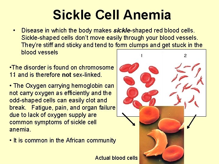 Sickle Cell Anemia • Disease in which the body makes sickle-shaped red blood cells.