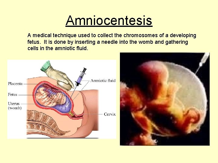 Amniocentesis A medical technique used to collect the chromosomes of a developing fetus. It