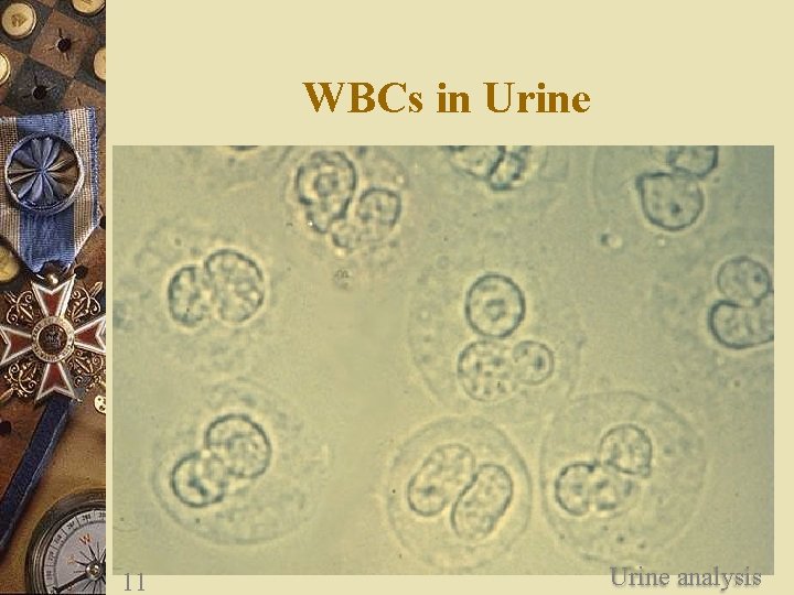 WBCs in Urine 11 Urine analysis 