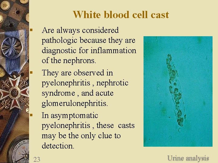 White blood cell cast § Are always considered pathologic because they are diagnostic for