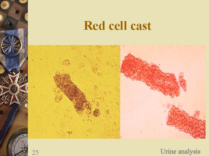 Red cell cast 25 Urine analysis 