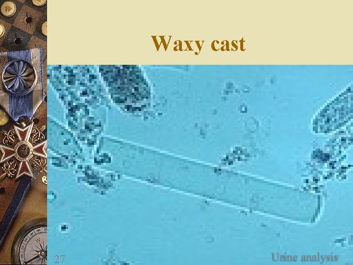 Waxy cast 27 Urine analysis 