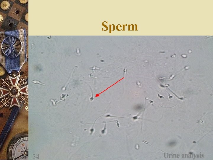 Sperm 34 Urine analysis 