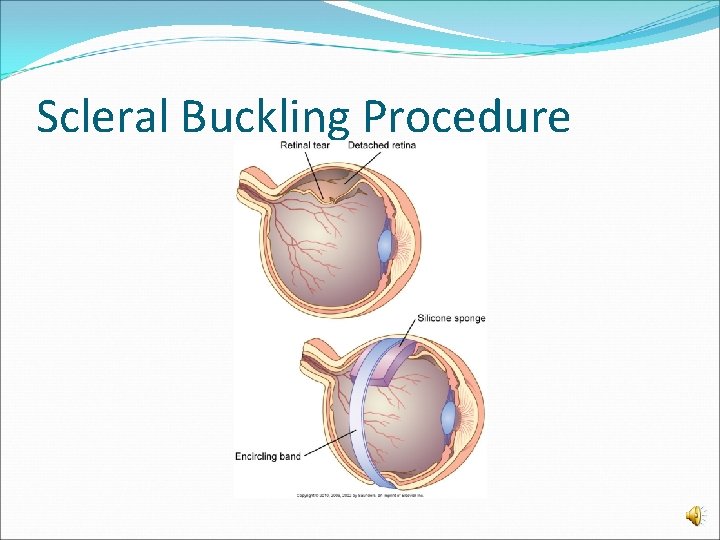 Scleral Buckling Procedure 