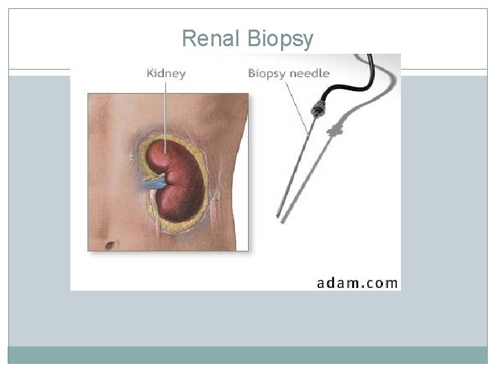 Renal Biopsy Renal Biopsy