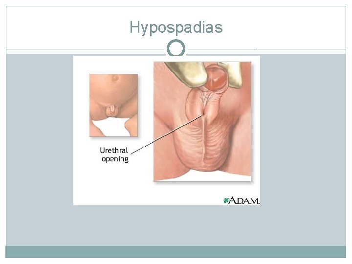 Hypospadias Hypospadias