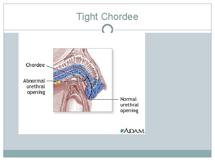 Tight Chordee Tight Chordee
