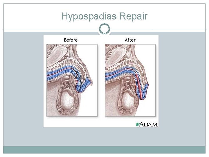 Hypospadias Repair Hypospadias Repair