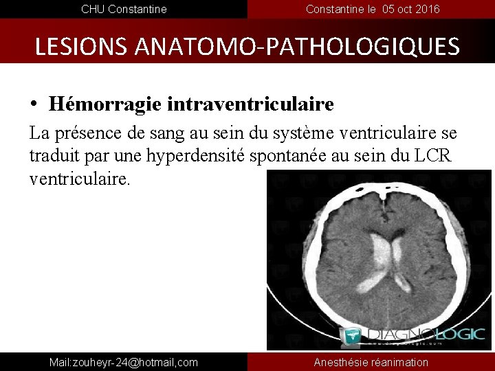  CHU Constantine le 05 oct 2016 LESIONS ANATOMO-PATHOLOGIQUES • Hémorragie intraventriculaire La présence