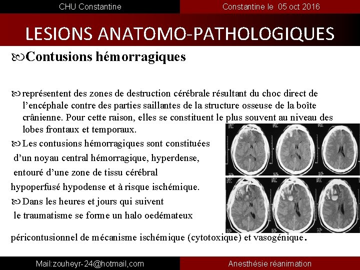  CHU Constantine le 05 oct 2016 LESIONS ANATOMO-PATHOLOGIQUES Contusions hémorragiques représentent des zones