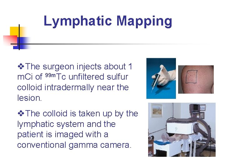 Lymphatic Mapping v. The surgeon injects about 1 m. Ci of 99 m. Tc