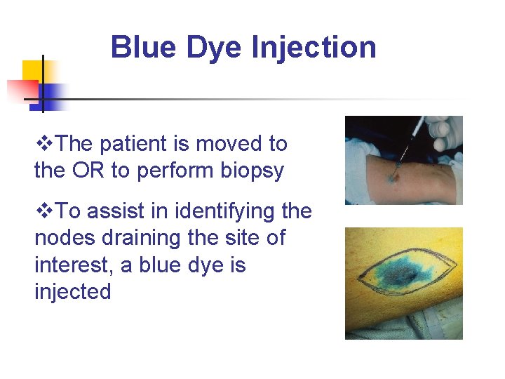 Blue Dye Injection v. The patient is moved to the OR to perform biopsy