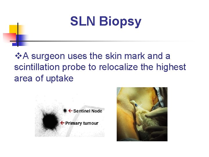 SLN Biopsy v. A surgeon uses the skin mark and a scintillation probe to