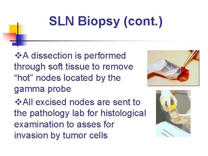SLN Biopsy (cont. ) v. A dissection is performed through soft tissue to remove