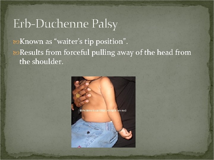 Erb-Duchenne Palsy Known as “waiter’s tip position”. Results from forceful pulling away of the