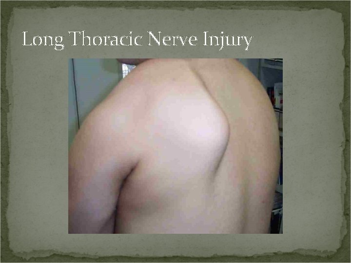 Long Thoracic Nerve Injury 