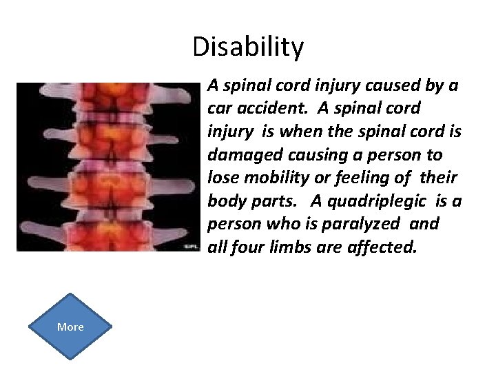 Disability A spinal cord injury caused by a car accident. A spinal cord injury