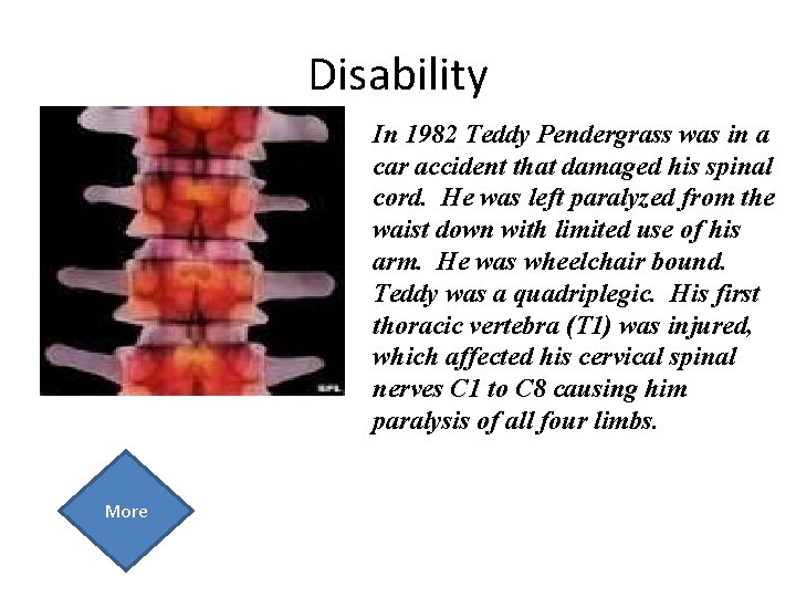 Disability In 1982 Teddy Pendergrass was in a car accident that damaged his spinal