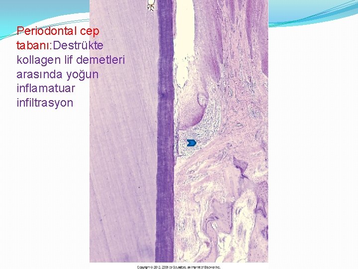 Periodontal cep tabanı: Destrükte kollagen lif demetleri arasında yoğun inflamatuar infiltrasyon 