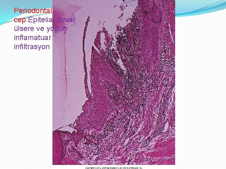 Periodontal cep: Epitelial duvar ülsere ve yoğun inflamatuar infiltrasyon 