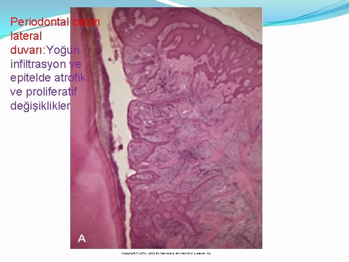 Periodontal cebin lateral duvarı: Yoğun infiltrasyon ve epitelde atrofik ve proliferatif değişiklikler 