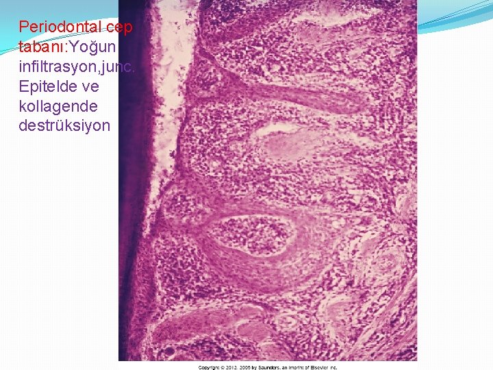 Periodontal cep tabanı: Yoğun infiltrasyon, junc. Epitelde ve kollagende destrüksiyon 