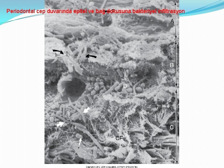 Periodontal cep duvarında epitel ve bağ dokusuna bakteriyel infiltrasyon 