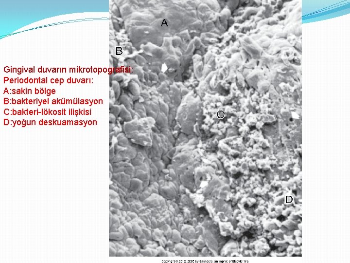 Gingival duvarın mikrotopografisi: Periodontal cep duvarı: A: sakin bölge B: bakteriyel akümülasyon C: bakteri-lökosit