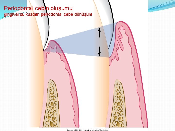 Periodontal cebin oluşumu gingival sulkusdan periodontal cebe dönüşüm 
