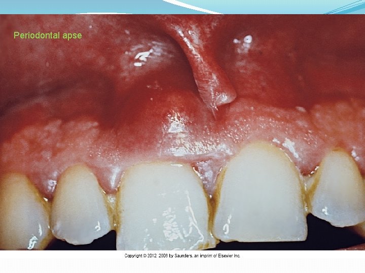 Periodontal apse 