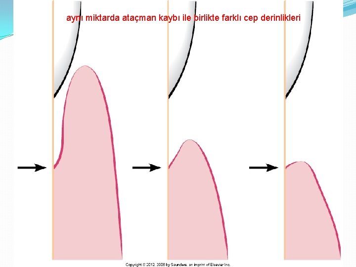 aynı miktarda ataçman kaybı ile birlikte farklı cep derinlikleri 