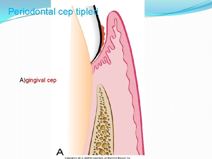 Periodontal cep tipleri A)gingival cep 