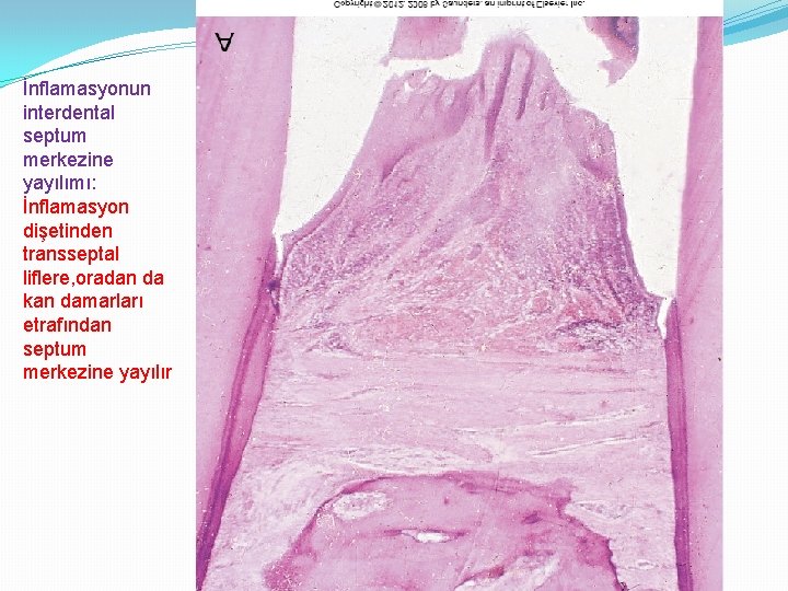 İnflamasyonun interdental septum merkezine yayılımı: İnflamasyon dişetinden transseptal liflere, oradan da kan damarları etrafından