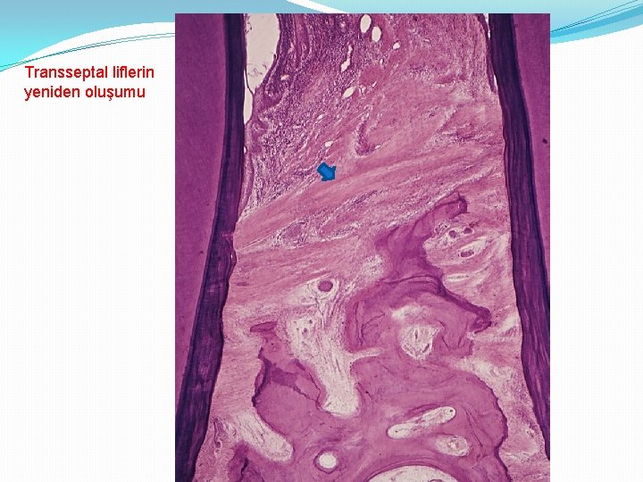 Transseptal liflerin yeniden oluşumu 