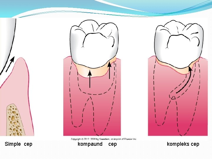 Simple cep kompaund cep kompleks cep 