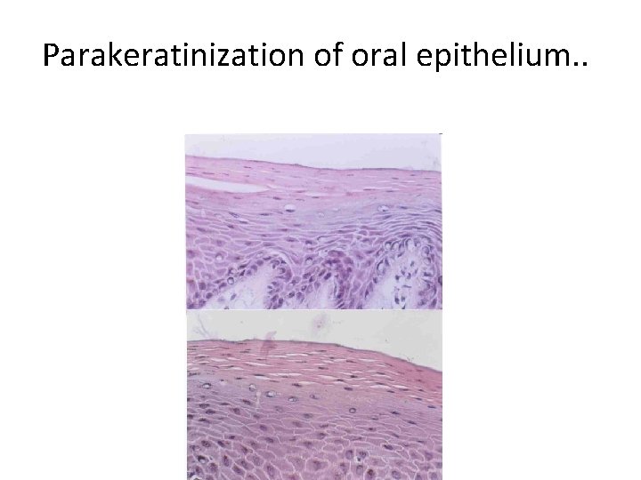 Parakeratinization of oral epithelium. . Parakeratinization of oral epithelium. .