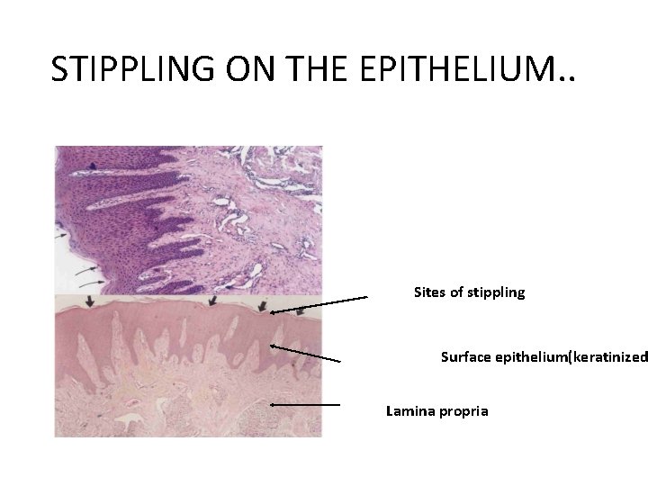 STIPPLING ON THE EPITHELIUM. . Sites of stippling Surface epithelium(keratinized Lamina propria STIPPLING ON THE EPITHELIUM. . Sites of stippling Surface epithelium(keratinized Lamina propria
