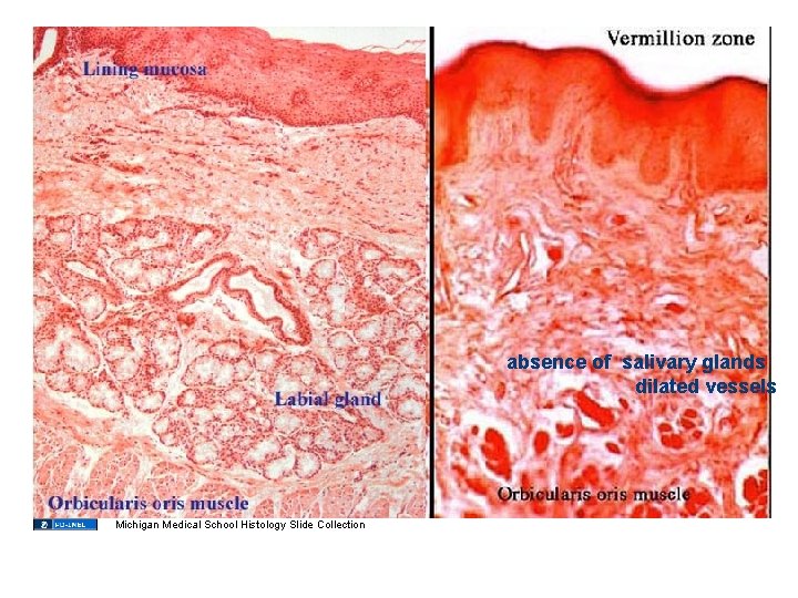 absence of salivary glands dilated vessels Michigan Medical School Histology Slide Collection absence of salivary glands dilated vessels Michigan Medical School Histology Slide Collection