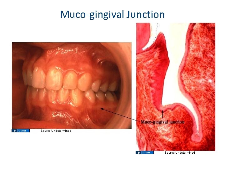 Muco-gingival Junction Source Undetermined Muco-gingival Junction Source Undetermined