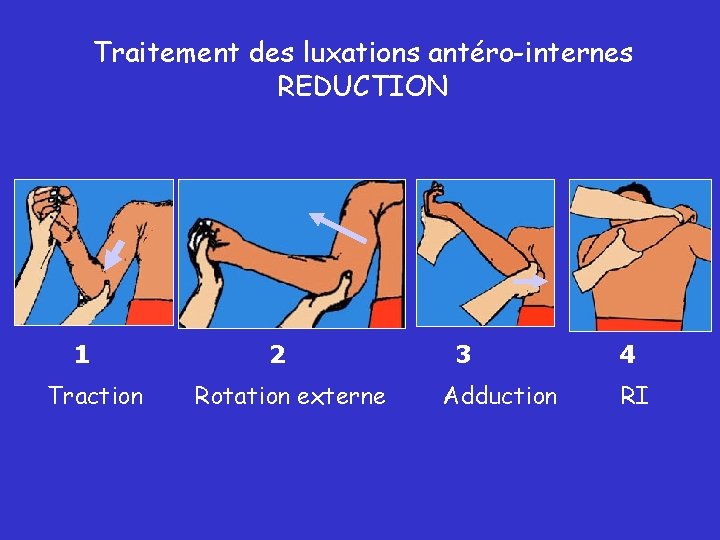 Traitement des luxations antéro-internes REDUCTION 1 Traction 2 Rotation externe 3 Adduction 4 RI