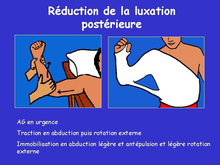 Réduction de la luxation postérieure AG en urgence Traction en abduction puis rotation externe Réduction de la luxation postérieure AG en urgence Traction en abduction puis rotation externe