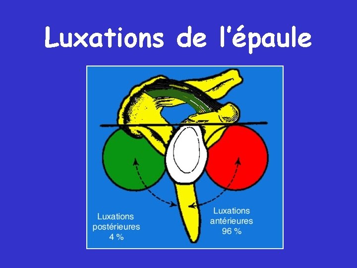 Luxations de l’épaule Luxations de l’épaule