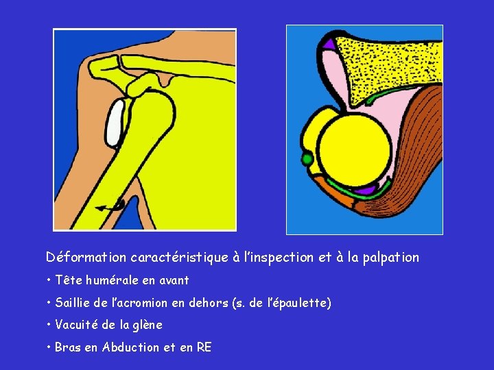 Déformation caractéristique à l’inspection et à la palpation • Tête humérale en avant •