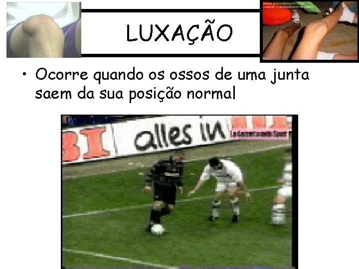 LUXAÇÃO • Ocorre quando os ossos de uma junta saem da sua posição normal