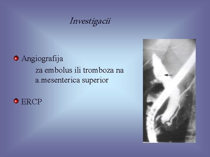 Investigacii Angiografija za embolus ili tromboza na a. mesenterica superior ERCP 32 