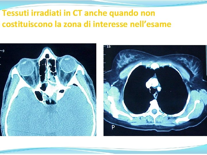 Tessuti irradiati in CT anche quando non costituiscono la zona di interesse nell’esame Lens