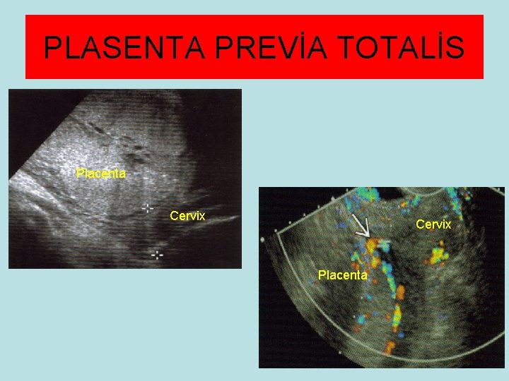 PLASENTA PREVİA TOTALİS Placenta Cervix Placenta 