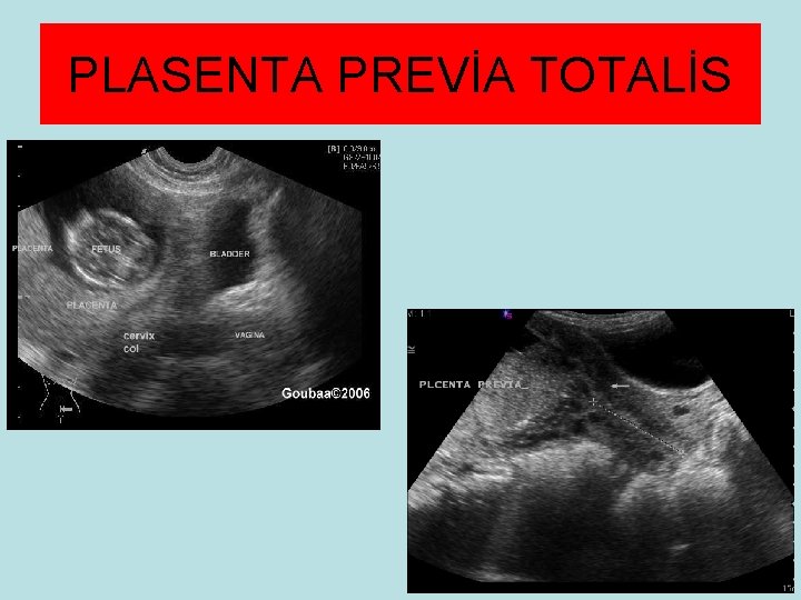 PLASENTA PREVİA TOTALİS 